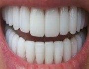 5 عادات يومية سيئة قد تضر بأسنانك وتتلفها