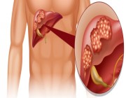 أعراض شائعة تكشف الإصابة بـ«سرطان الكبد».. استشر طبيبك فوراً