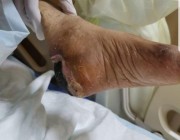أسرة مريضة سبعينية تتهم مستشفيين بجدة بالتسبب في بتر قدمها.. و”صحة جدة” ترد