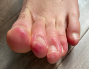 «كوفيد الأصابع».. كل ما تحتاج معرفته عن أصابع القدم المصابة بفيروس كورونا