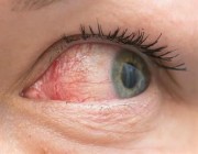 الجفاف أكثر أمراض العيون انتشاراً ويؤدي إلى العمي.. وهذه مسبباته وطرق الوقاية منه