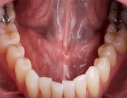 استشاري: أمراض الفم واللثة منتشرة بشكل كبير في المملكة (فيديو)