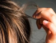 تحذير طبي من مضاعفات مرض غريب يتسبب في تساقط الشعر مبكراً
