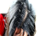 كيف تحمي شعرك من القشرة في الشتاء؟