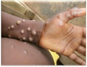 عالم مناعة يكشف الفئات الأكثر احتياجًا إلى التطعيم ضد «جدري القرود»