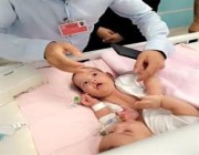 شاهد.. دخول التوأم السيامي اليمني “مودة ورحمة” إلى غرفة العمليات استعداداً لفصلهما