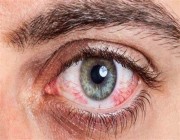احمرار العين والحكة المستمرة.. أعراض الإصابة بحساسية العين وأسبابها