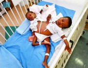 إجراء عملية فصل التوأم السيامي التنزاني “حسن وحسين” يوم غدٍ الخميس
