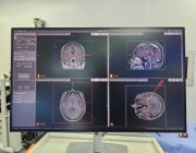 ” فهد الطبية ” تطبق جراحة الفراغ الكهربائي للدماغ