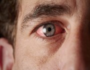 طبيب عيون يوضح الفرق بين الماء الأبيض والجلوكوما وأسباب الإصابة بهما