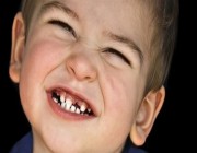 تعرف على أسباب «طحن الأسنان» لدى الأطفال.. وطرق العلاج