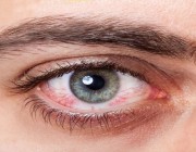 أسباب جفاف العين وأعراضها وطرق العلاج