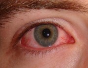 استشاري يوضح أسباب ارتفاع معدلات الإصابة بـ”جفاف العين” (فيديو)