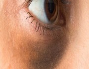 أسباب ظهور «الهالات السوداء» أسفل العين.. وأفضل طرق العلاج