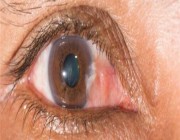 “سعود الطبية” تحذر: كثرة التعرض لأشعة الشمس تسبب مشاكل في ظفرة العين فتجنبوها