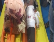 إصابة مهندس في “مسام” بانفجار لغم حوثي أثناء عمله