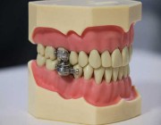 لمحاربة السمنة .. علماء يطورون “قفل على الأسنان” يمنع الأكل