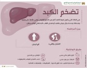 “فهد الطبية” توضح أعراض تضخم الكبد وطرق الوقاية منه