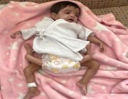 شاهد.. بدء عملية فصل التوأم الطفيلي اليمني “عائشة”.. ووالدها يعلق