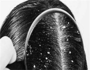 قشرة الرأس هل تسبب تساقط الشعر؟… خبيرة تجيب
