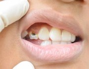 “الصحة”: المملكة سجلت أعلى معدلات الإصابات بتسوس الأسنان حول العالم لهذه الأسباب