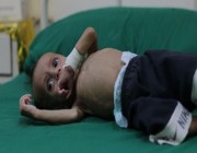 نجت من الغارات فأصيبت بالهزال.. مأساة رضيعة يمنية تحت القصف الحوثي الغادر