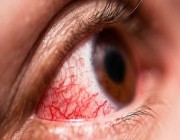 أبرزها الجفاف والحكة.. 5 أعراض تظهر على العين تكشف الإصابة بكورونا
