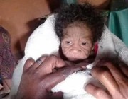 في حالة نادرة.. ولادة طفلة بشيخوخة مبكرة في جنوب إفريقيا (صور)