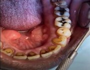 شاهد.. طبيبة تكشف مصير أسنان المدخنين من خلال تجربة عملية