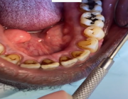 فيديو صادم.. طبيبة أمريكية توثق أضرار التدخين على الأسنان