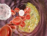 استشاري يكشف أفضل الطرق للتحكم  بنسبة «الكوليسترول» بالدم