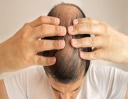 دراسة حديثة تكشف عن حل سحري للقضاء على تساقط الشعر والصلع الوراثي