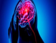 “فهد الطبية” تكشف عن عوامل الإصابة بالسكتة الدماغية وأسباب حدوثها