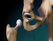 تُحسن حركة المفصل.. عسيري يكشف تفاصيل التقنية الجديدة لعملية “استبدال الركبة” (فيديو)