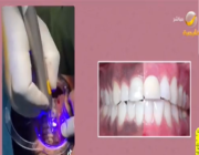 أخصائي تجميل أسنان يكشف عن أسباب ظهور تصبغات اللثة.. وكيفية معالجتها