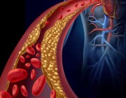 استشاري قلب يكشف عن النسبة المثالية للكوليسترول الضار بالجسم