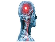 “فهد الطبية” توضح ما المقصود بتمدد الأوعية الدموية الدماغي وما هي أعراضه وعوامل خطورته