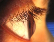 ‏”استشاري”: الوراثة ​وفرك العين يؤديان للإصابة بالقرنية المخروطية.. وهذه مضاعفاتها وطرق علاجها