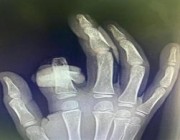 مستشفى بالطائف ينقذ أصبع طفل من البتر بعد تعرضه للتهتك بسبب غسالة