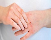 “استشاري جلدية” يكشف أشهر 7 أسباب لتهيج الصدفية