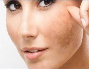 بقع الوجه والبقع الداكنة على الجلد: الأسباب وكيفية علاجها