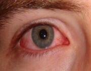 مرض معد يصيب العين.. “فهد الطبية” توضح ما هو “التراخوما” وأعراضه وكيفية العلاج منه
