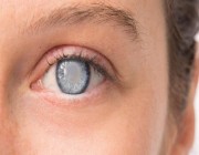 طبيبة تكشف خطورة ارتفاع ضغط العين والغلوكوما