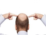 ​طبيب جلدية يوضح مدى تأثير لبس “الشماغ” والحالة النفسية على تساقط الشعر