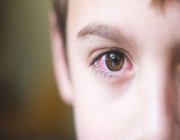 “تخصصي العيون” يوجه 3 نصائح مهمة للوقاية من أضرار الغبار
