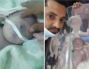 توفي بعد ساعات من نقله للحضانة.. ولادة نادرة لطفل بعين واحدة في مستشفى باليمن