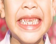” الصحة”: 9 أسباب لتسوس الأسنان و3 إرشادات لتخفيف آثارها