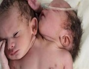 ولادة نادرة لتوأم برأسين و3 أذرع في الهند