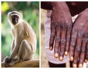 «جدري القرود».. تعرّف على قائمة بدول العالم التي تفشى بها الفيروس