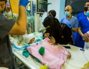 نجاح فصل التوأم السيامي اليمني “يوسف وياسين” في عملية استغرقت 15 ساعة